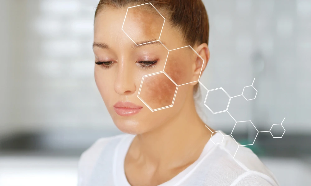 melasma 2